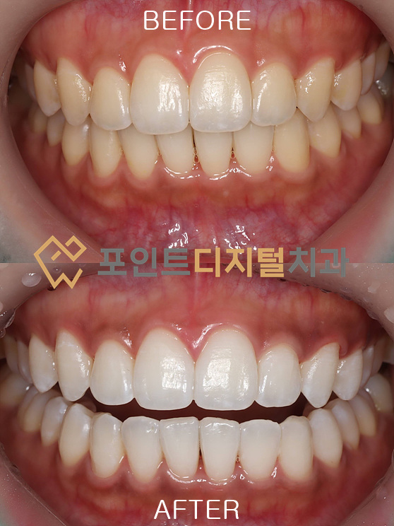 [천안/아산 치아미백] 말뿐인 설명 대신, 저희는 '결과(전후 사진)'로만 증명합니다.