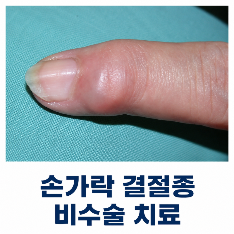 손가락 마디 혹·발가락 혹 원인? 결절종일 수 있습니다