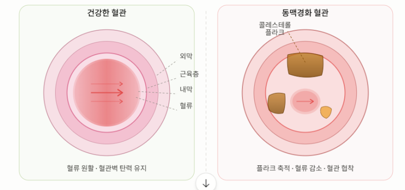 동맥경화- 이것은 현상이 아니고 갱년기 여성과 남성에게는 치명적인 질환입니다.