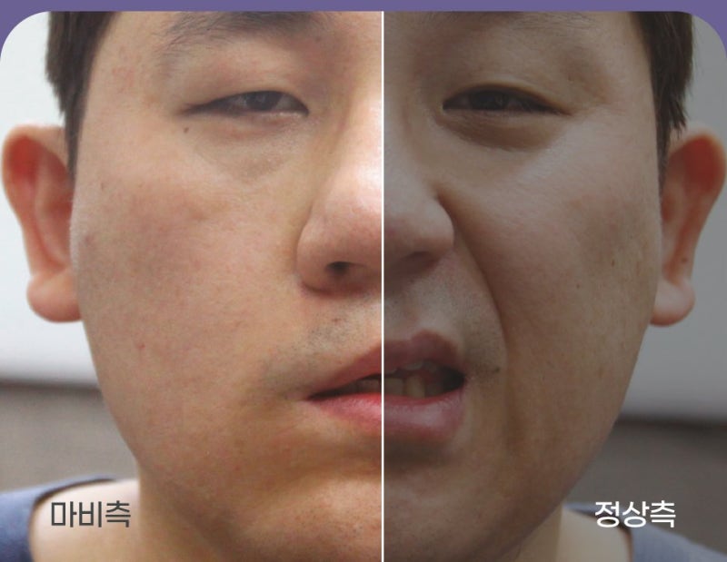 안면마비 치료 한방 vs 양방, 구안와사라면 이렇게 선택하세요( 치료약·치료방법 비교)