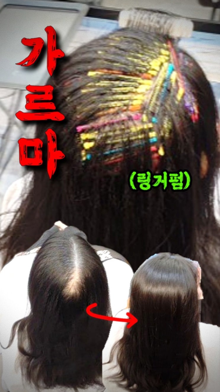 천안 불당동 가르마탈모 고민? 수원 율전동 모류교정 링거펌으로 긴머리 정수리 볼륨 되살린 후기