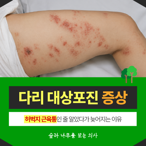 다리 대상포진 증상 허벅지 근육통인 줄 알았다가 늦어지는 이유 (초기 증상 후유증)