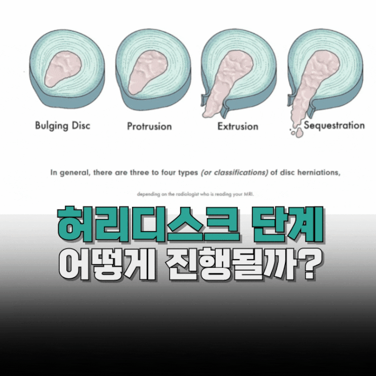  허리디스크는 어떻게 진행될까? 단계별로 설명드립니다