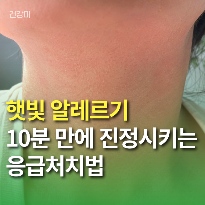 햇빛 알레르기 목 수포와 부음,10분 만에 급진정시키는 응급처치법