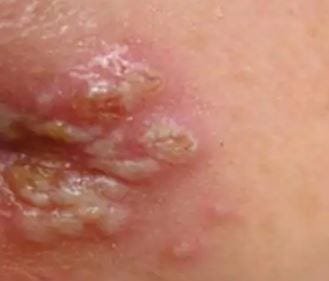 HPV 바이러스 잠복기,아무 증상 없다가 뒤늦게 후회한..