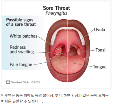 인후염의 증상과 빨리 낫는 법
