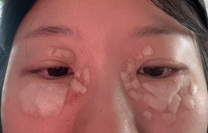 눈밑한관종 두 달만에 재발 아그네스 후기 덜 아프게 시술하는 방법