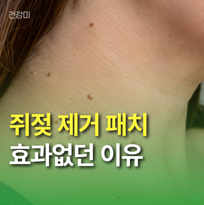 쥐젖 제거 패치 효과없던 이유, 진짜 문제는 ‘뿌리’ 가 아니었습니다