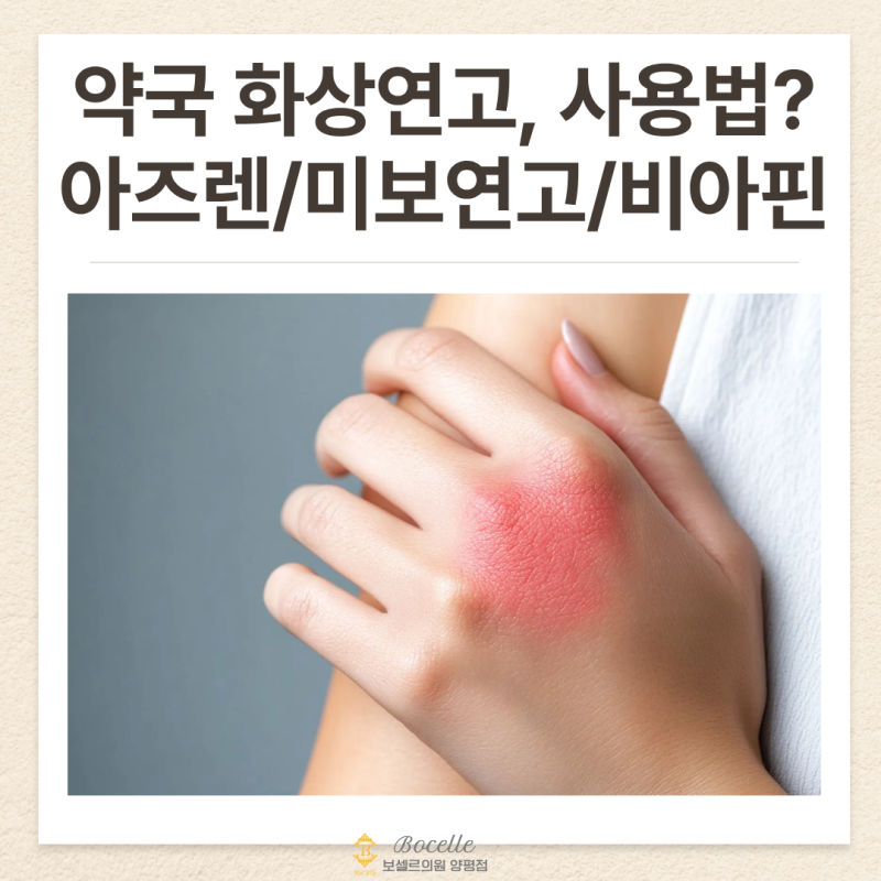 화상 입었을 때 약국 연고 처치법, 미보연고 비아핀연고 아즈렌연고 바스포 메디폼 등