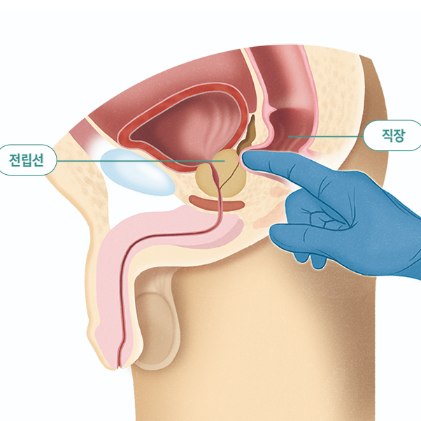전립선 검사 종류 방법, 야뇨 잔뇨 빈뇨 약국 약 추천, 소변을 시원하게