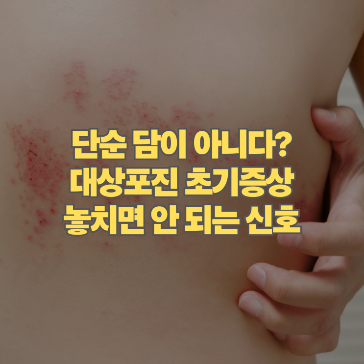  단순 담 걸린 게 아니다? 대상포진 초기증상 의외의 신호