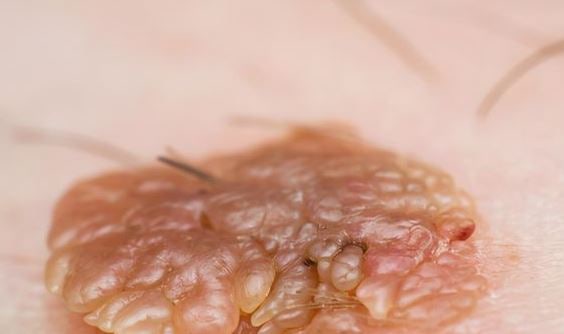 HPV 사마귀 완치까지,모양부터 관리 방법까지 총정리