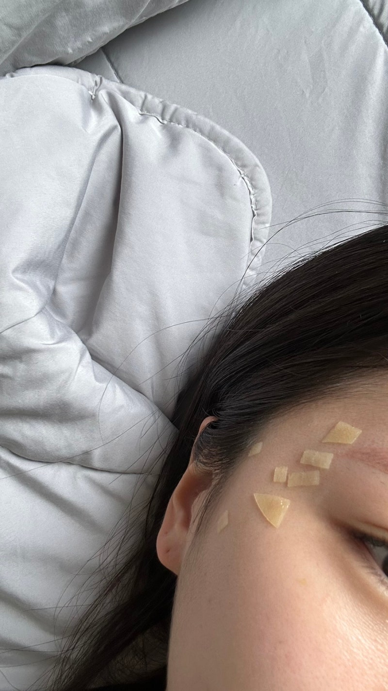 용인 수원 편평사마귀 실손 된다길래 피부과 8곳 전화해봤습니다… 현실은 이랬어요
