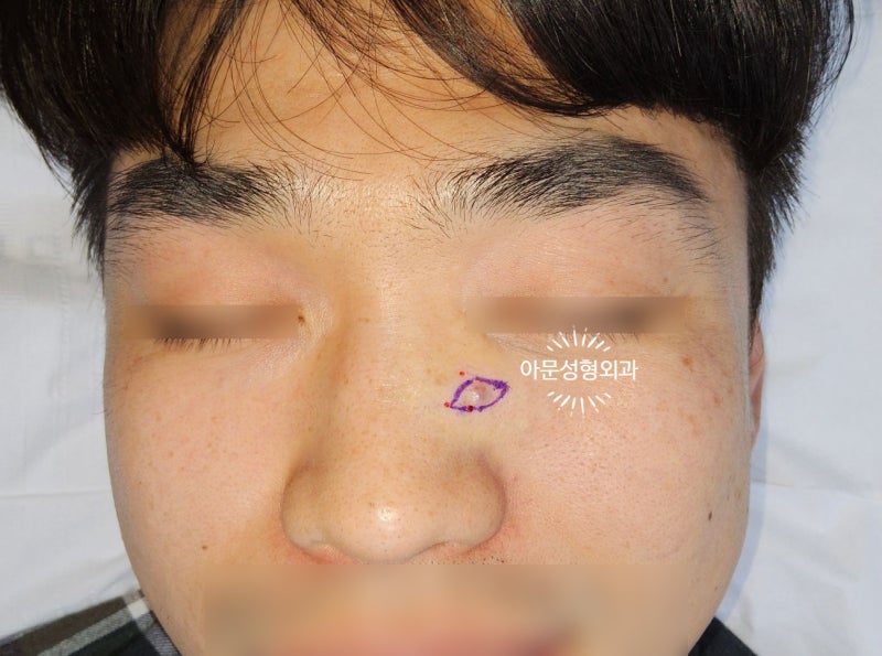 얼굴 혈관종, 수술시 주의점은? (서울 강동구 아문성형외과)