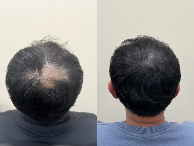 청라두피문신, 부작용 걱정 없이 자연스럽게 탈모커버하는 방법