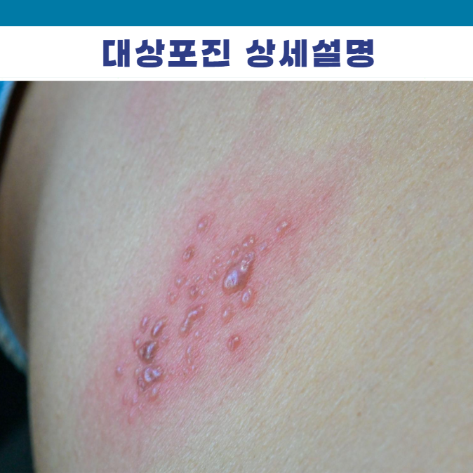 대상포진 뜻 원인 바이러스 VZV 역학 병태생리 증상 전염 합병증 진단 검사 치료 간호 방법