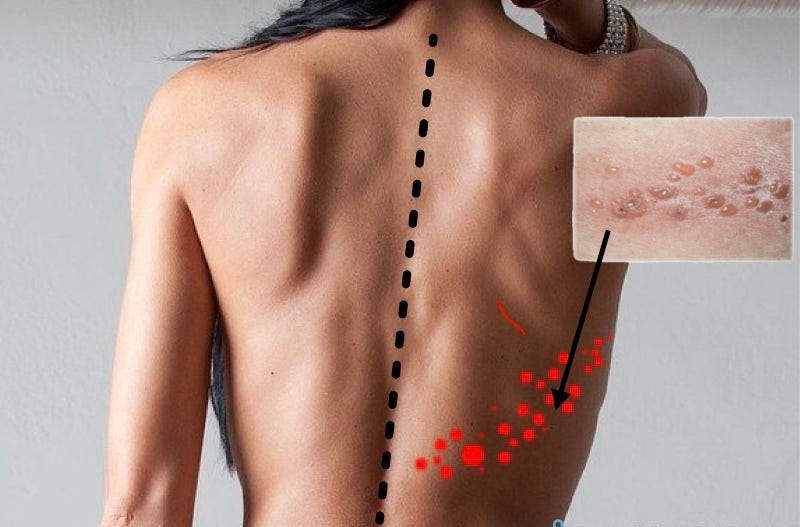 대상포진증상: 초기부터 합병증까지 전 과정 완벽 정리｜왜 생기고 어떻게 구별할까?