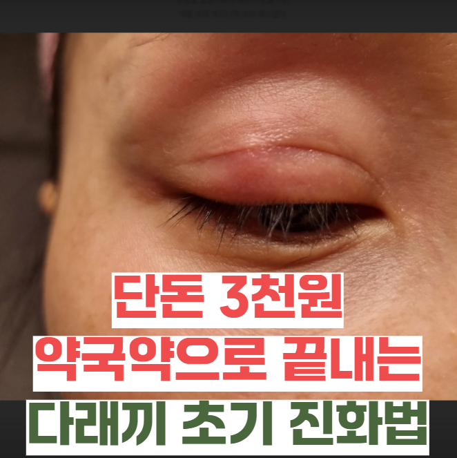 노란 알갱이 보이기 전, 단돈 3천 원 약국 약으로 끝내는 '다래끼 초기증상' 진화법