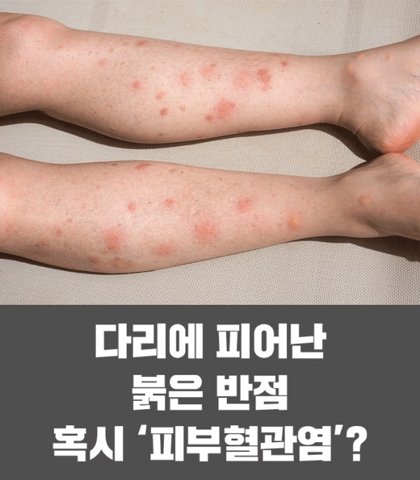 3가지 이상 겹치면 진료 필수 신장 침범 가능성 나타내는 성인자반증 진행 패턴