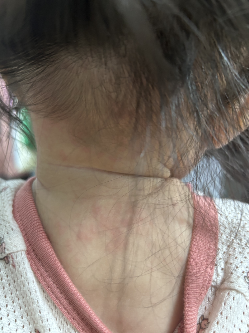 장염 끝난 줄 알았는데… 갑자기 두드러기가 올라왔어요/아스트로바이러스 장염 후 겪은 우....