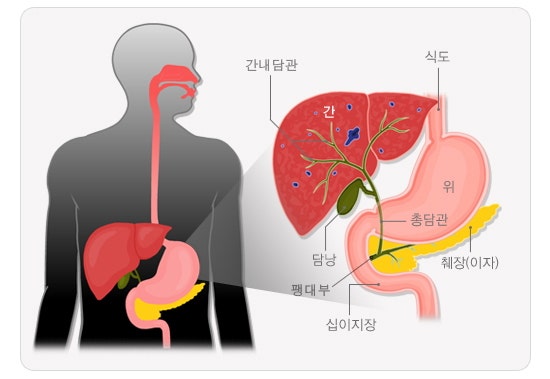 [담관] 급성 담관염