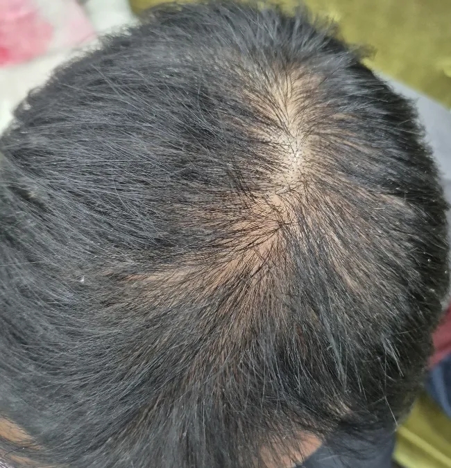  정수리탈모 와 원형탈모 차이 , 그리고 전주두피문신 으로 해결될까요?