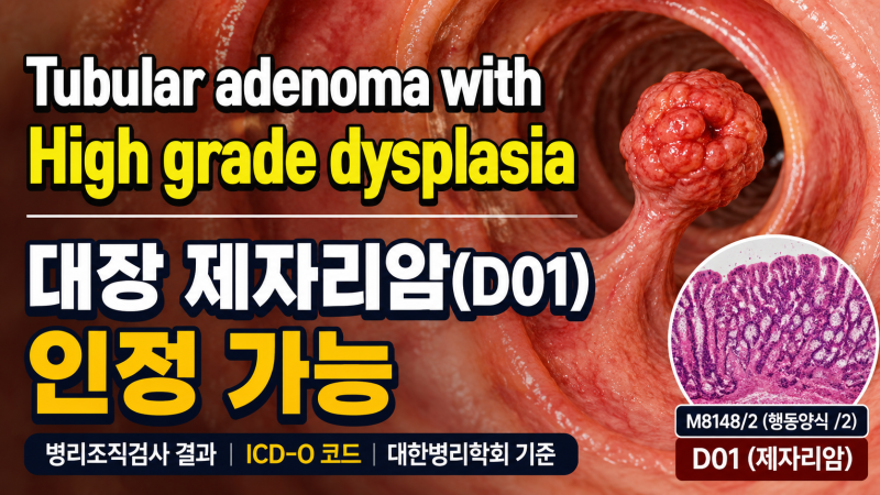 [ 수원손해사정사 ] 대장 고등급 이형성증(HGD), 제자리암(D01) 인정 가능할까? 병리조직검사와 ....