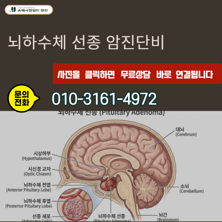  뇌하수체 선종 암진단비, D35.2 양성 종양으로 거절당한 보험금 전액 수령한 실무 전략