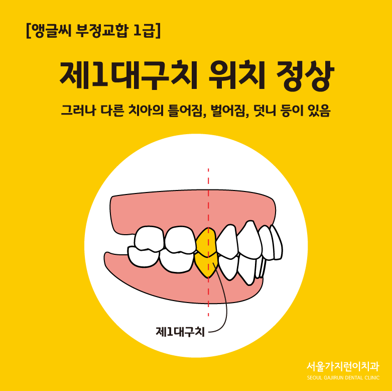 어린이 부정교합 치과보험 보장 기준이 궁금하다면?