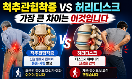 척추관협착증 vs 허리디스크, 가장 큰 차이