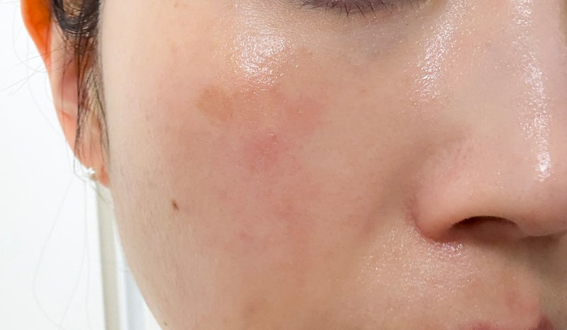 에스트라 아토베리어 AI 크림 MD 얼굴 햇빛알레르기 처방 후기