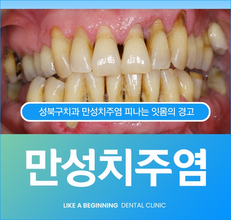만성치주염 피나는 잇몸의 경고