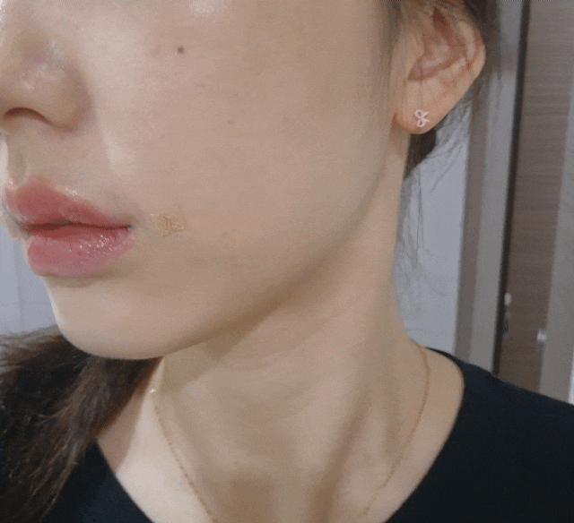 강남역피부과 : 고우리 콜라겐 팔자관리, GOURI 볼륨