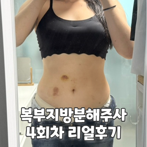  복부 지방분해주사성분까지 꼼꼼 비교해본 내돈내산 4회차 후기