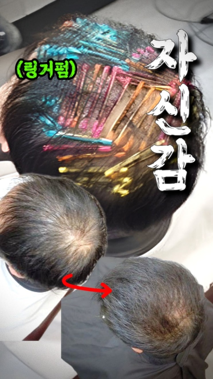  [인천 정수리탈모 미용실] 흑채 없이 자신감 찾은 50대 남성 리얼 후기｜수원 율전동 아엠헤드 모류교정 링거펌