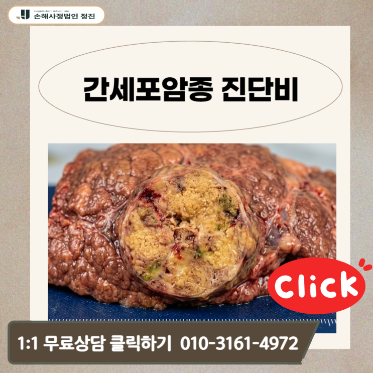  간세포암종 진단비, 조직검사 없이 전액 수령한 비밀 보상 대공개