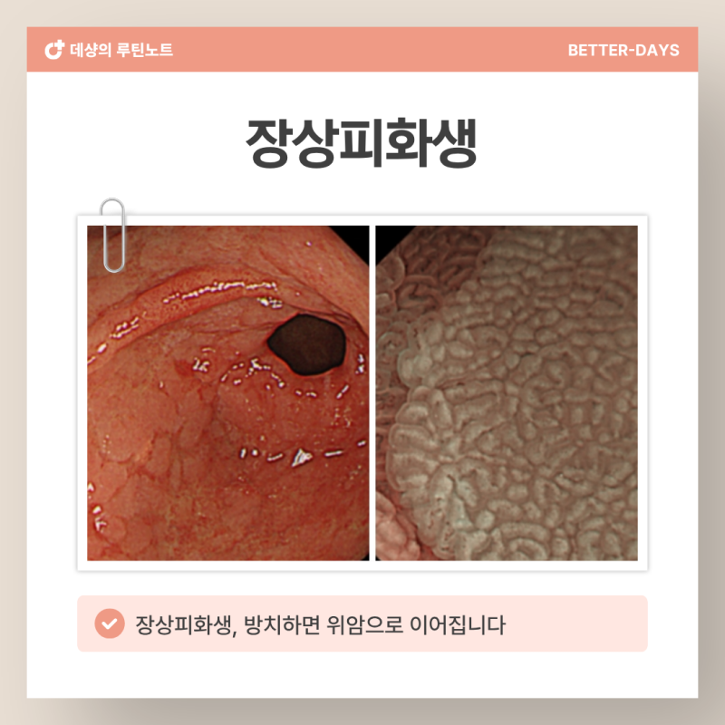 장상피화생, '이 단계' 넘어가면 위암으로 가는 길이 열립니다