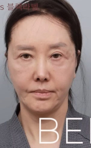   유혜리 안면거상 후 확 달라진 근황, 안경까지 벗게 된 이유