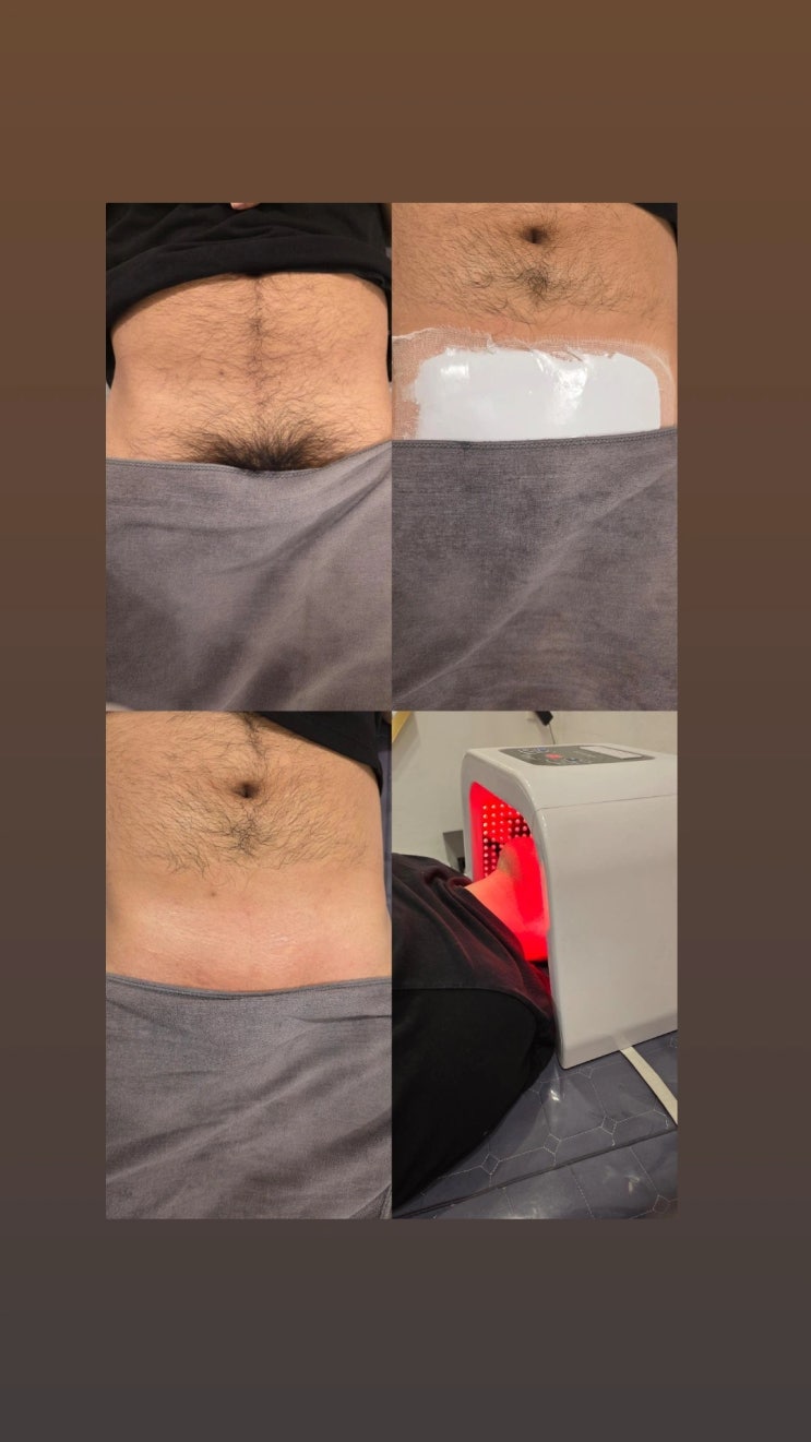  남자 브라질리언 왁싱은 진정 케어 풀세트 무료에 이벤트 적용까지. 영등포 왁싱샵 "청춘케어"