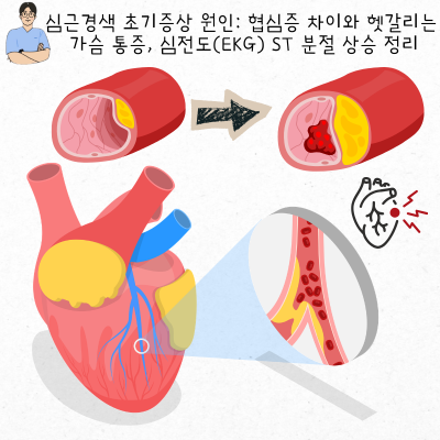 심근경색 초기증상 원인 및 협심증 차이와 헷갈리는 가슴 통증, 심전도(EKG) ST 분절 상승 정리