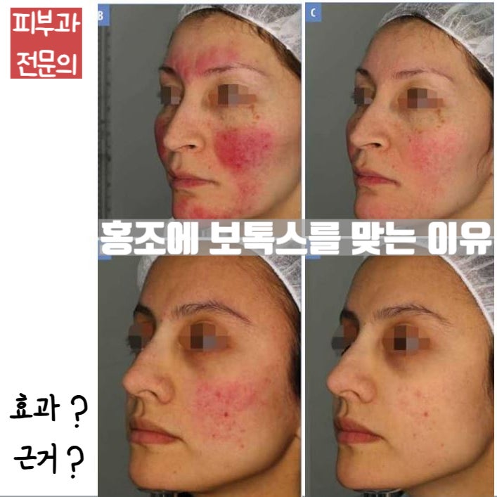  안면홍조/주사피부염에 스킨보톡스를 맞는 이유 (효과? 근거? 전후사진)