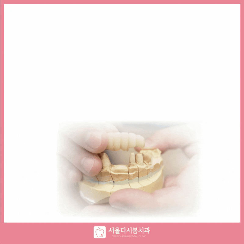 천안 아산 브릿지 치료 양옆 치아 삭제 장단점 수명 비용