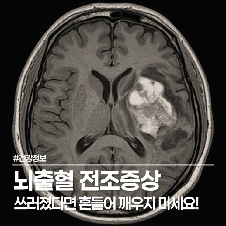  뇌출혈 전조증상, 단순 두통인 줄 알고 누웠다간 정말 큰일