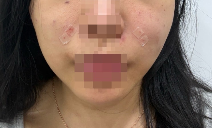  부산 서면실리프팅 내돈내산 후기(부작용, 통증,마취, 효과, 회복기간)