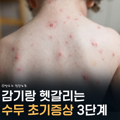 감기랑 헷갈리는 수두 초기증상 전염 격리 예방접종! 아기 성인 차이점