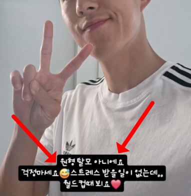  손흥민 원형탈모 본인이 직접 밝힌 한마디"스트레스 없는데..."