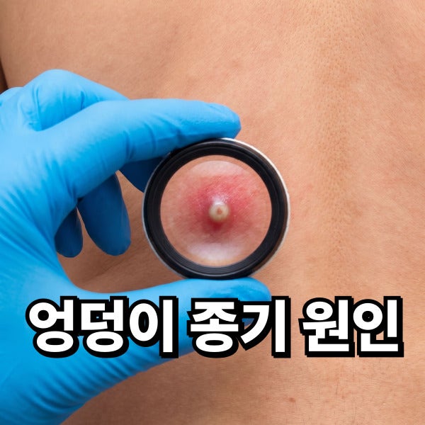 앉기 힘들 정도로 아픈 통증 엉덩이 종기 원인·고름·연고 치료 방법