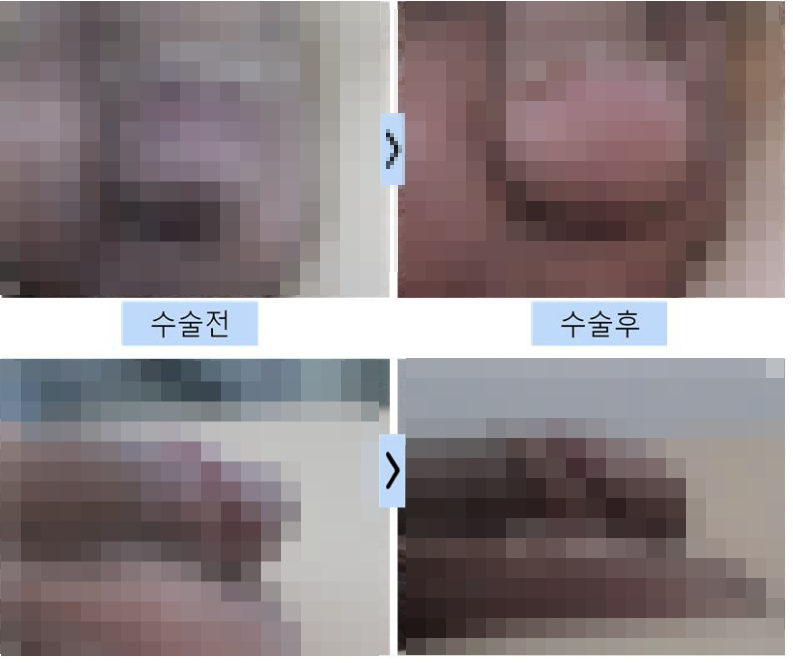 음경확대복합수술, 7000건 집도의가 말하는 조합 선택 기준
