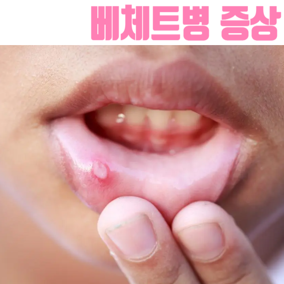 재발하는 구내염, 혹시 베체트병? 증상 원인 치료, 자가면역질환