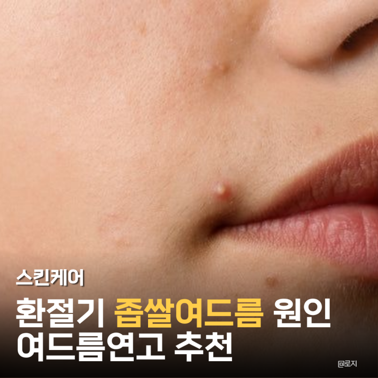  환절기 좁쌀 여드름 원인 없애는법 연고 사용법